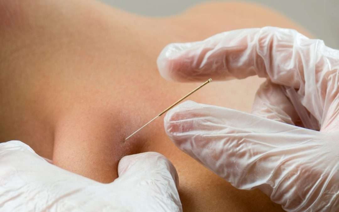 Dry Needling